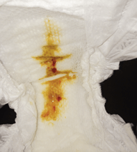 Used diaper with yellow and orange stain